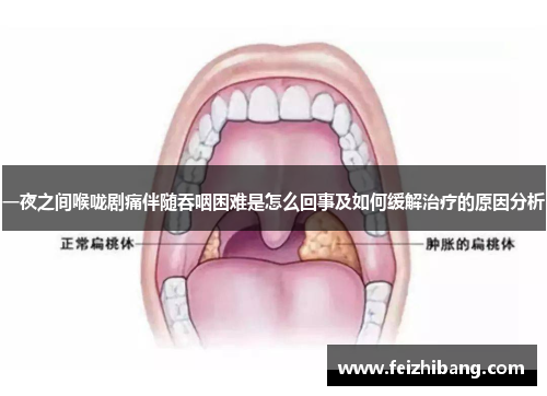 一夜之间喉咙剧痛伴随吞咽困难是怎么回事及如何缓解治疗的原因分析 一夜之间喉咙剧痛伴随吞咽困难是怎么回事及如何缓解治疗的原因分析