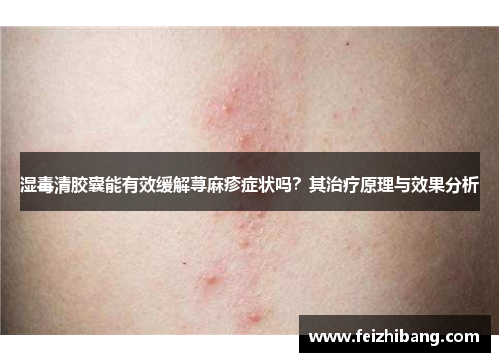 湿毒清胶囊能有效缓解荨麻疹症状吗？其治疗原理与效果分析